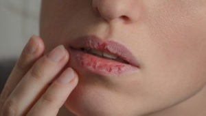 ¿Cómo tratar los labios resecos?