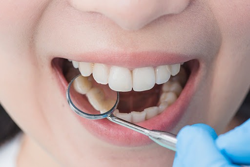 ¿Cómo eliminar el sarro de los dientes?