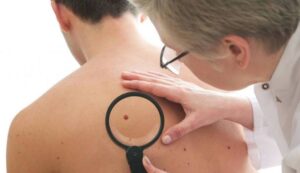 Cómo detectar un melanoma