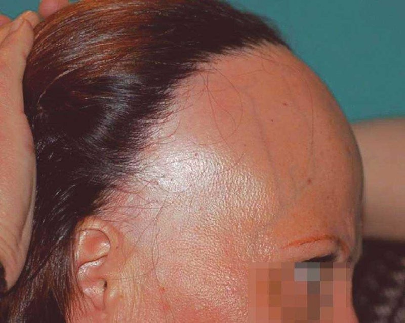 Principales tipos de Alopecia femenina